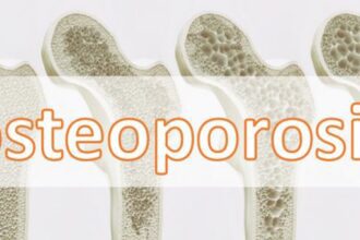Osteoporosis Image