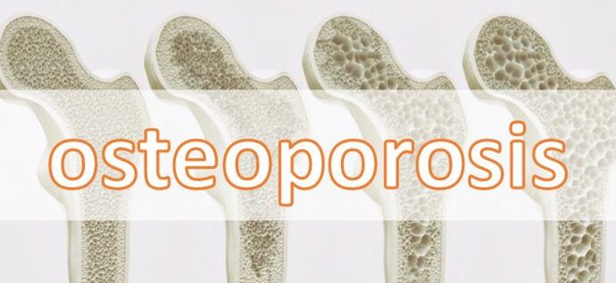 Osteoporosis Image