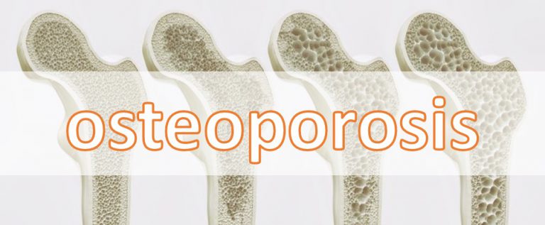 Osteoporosis Image